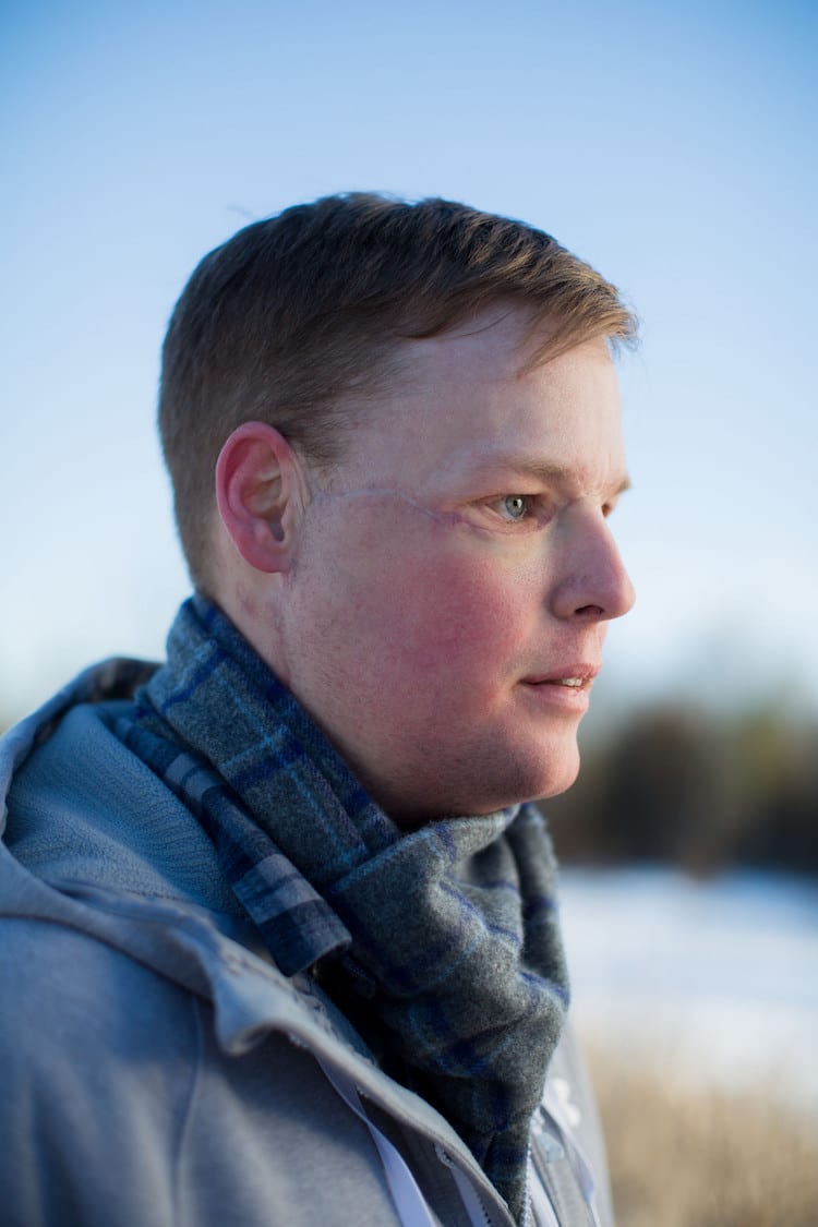 first face transplant andy sandness mayo clinic