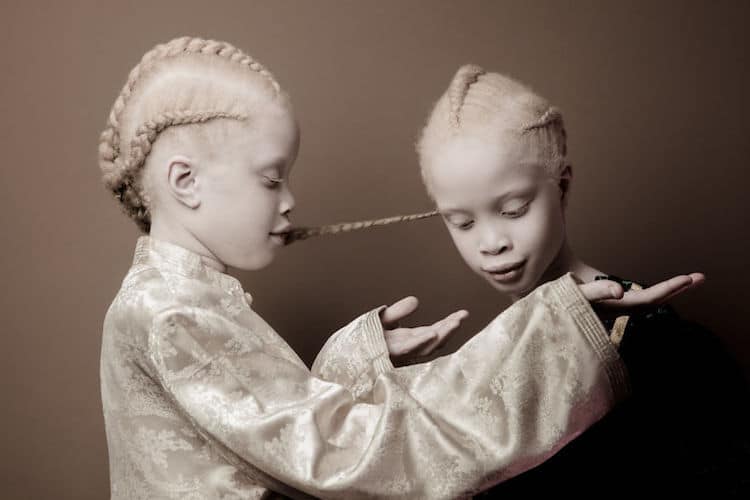 model with albinism