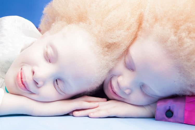 models with albinism