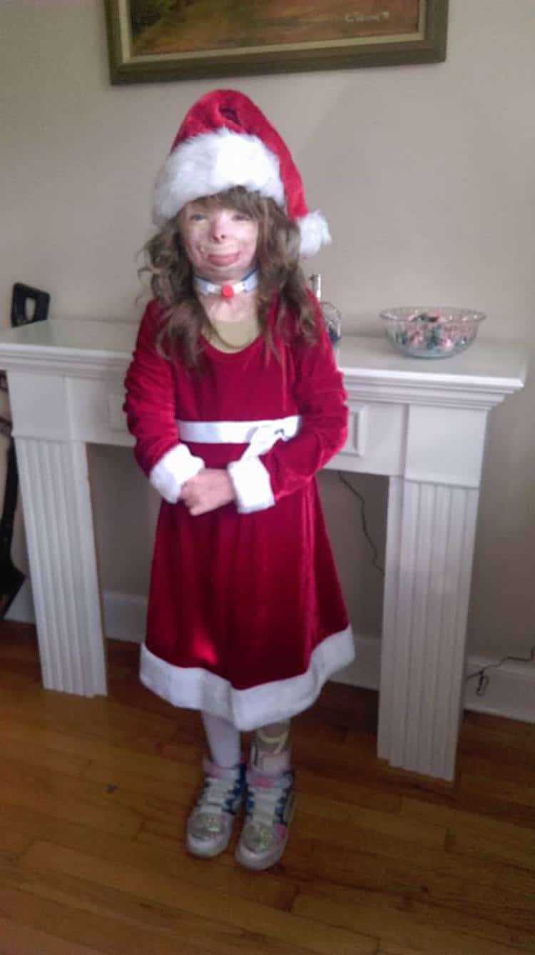 Little Girl Severely Burned In Arson Attack Only Wants Cards For Christmas Let S Send Her Some