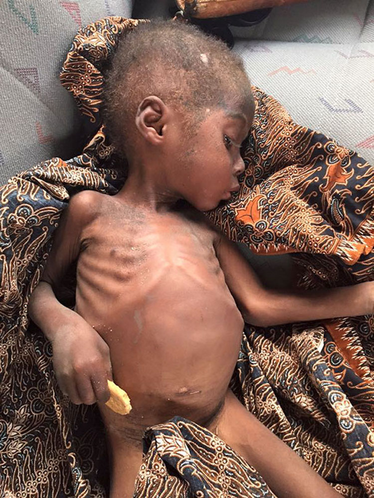 3-Year-Old Boy Named Hope Now Thrives After Almost Starving