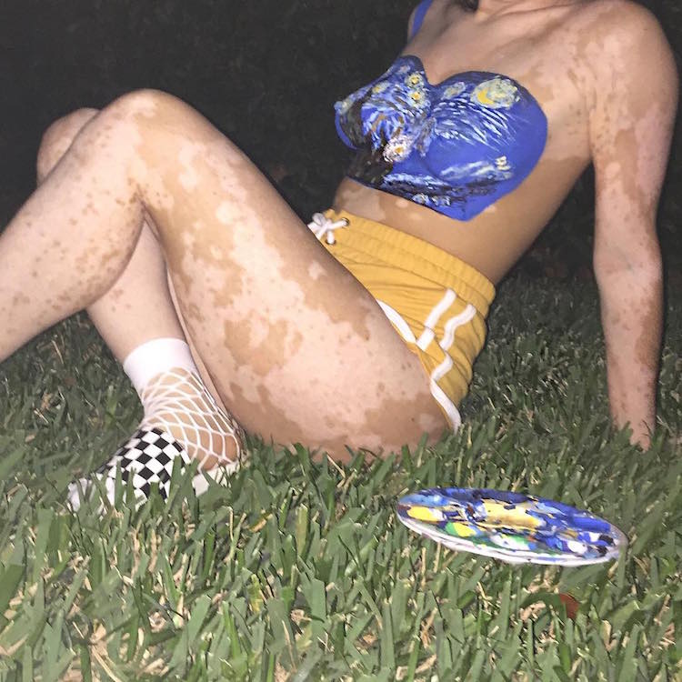 ash soto body positivity vitiligo