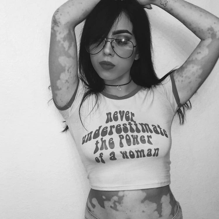 ash soto body positivity vitiligo