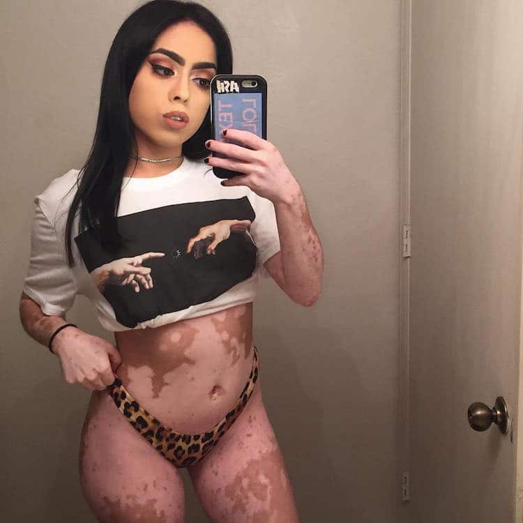 ash soto body positivity vitiligo