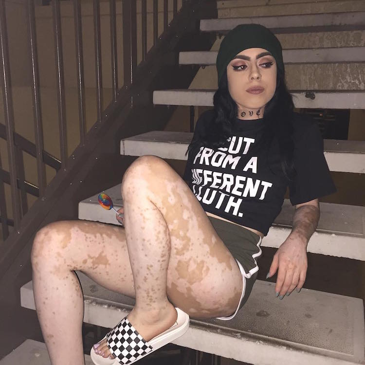 ash soto body positivity vitiligo