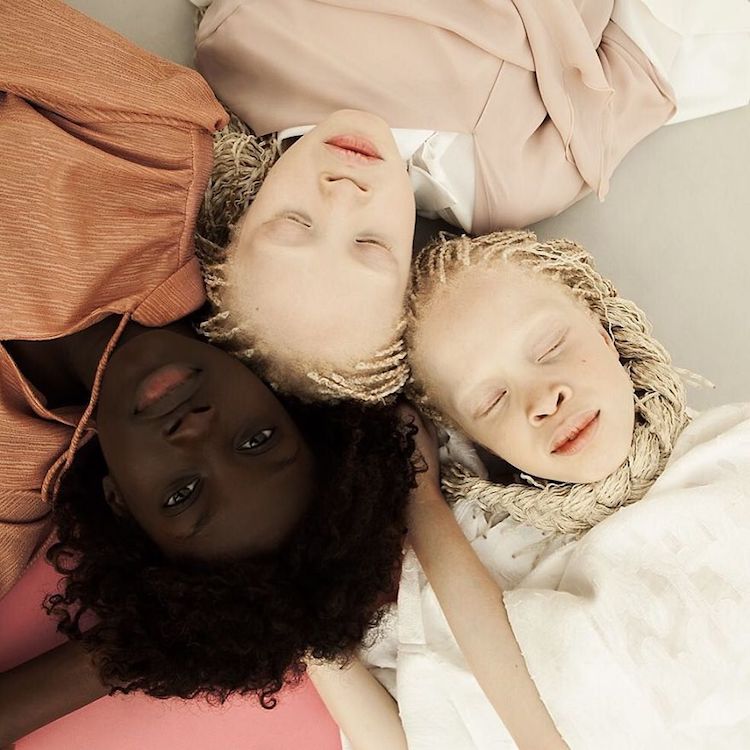 Gemelas Modelos con Albinismo