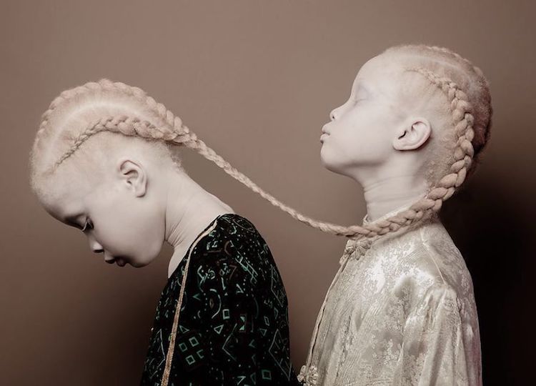 model with albinism