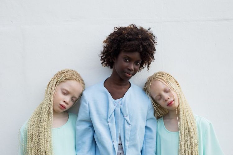 Gemelas Modelos con Albinismo