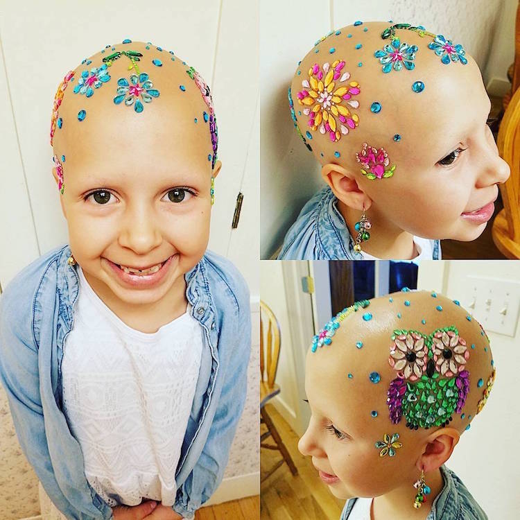 Crazy Hair Day Creatively Celebrated by Girl With Alopecia