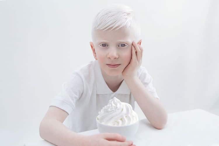 Porcelain Beauty 2 Yulia Taits Pictures of Albinism People with Albinism