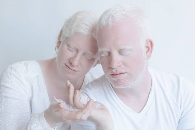 Porcelain Beauty 2 Yulia Taits Pictures of Albinism People with Albinism