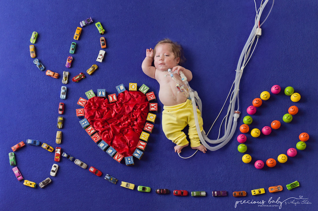 Precious Baby Project Angela Forker Bebés con discapacidad
