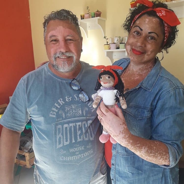 Muñecas con vitiligo