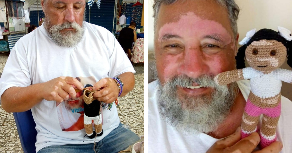 Grandfather With Vitiligo Crochets Dolls With Vitiligo for Kids to Feel