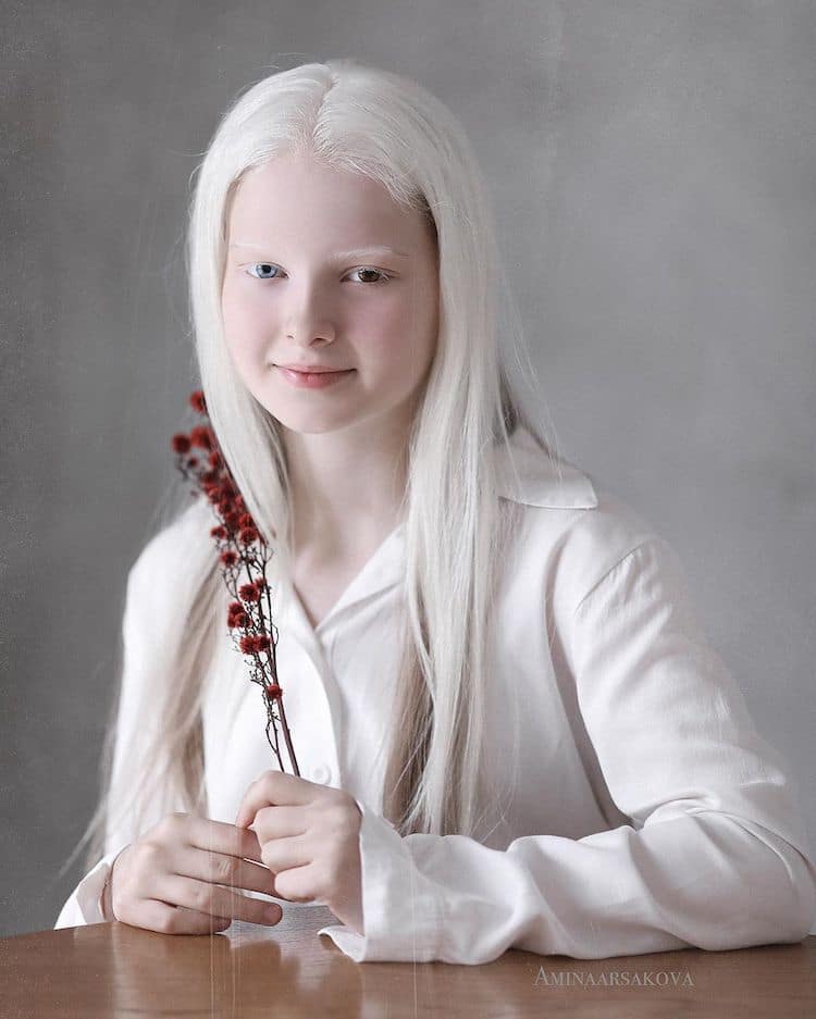 niña con albinismo y heterocromía
