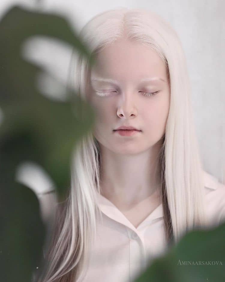 persona con albinismo y heterocromía