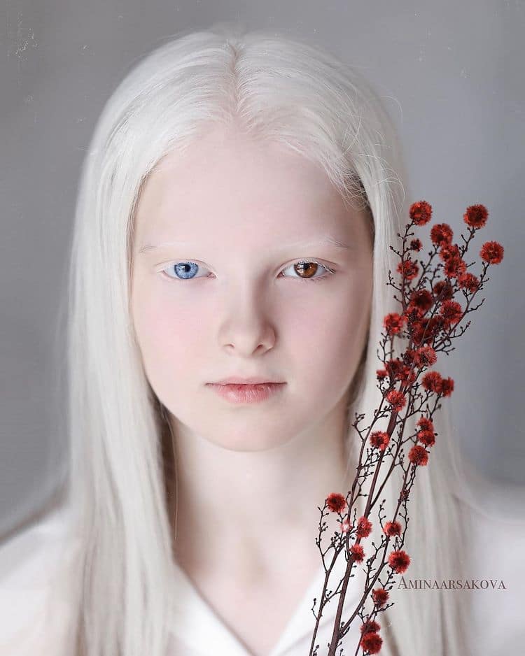 Amina Ependieva, niña con albinismo y heterocromía