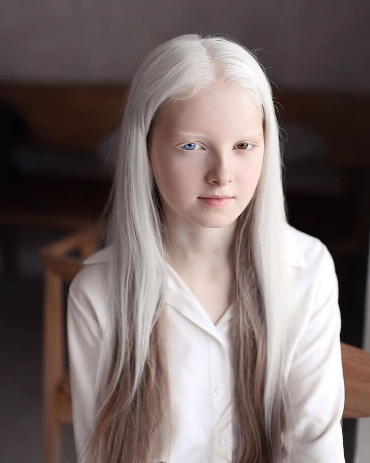 Amina Ependieva, Girl With Heterochromia Albinism and d