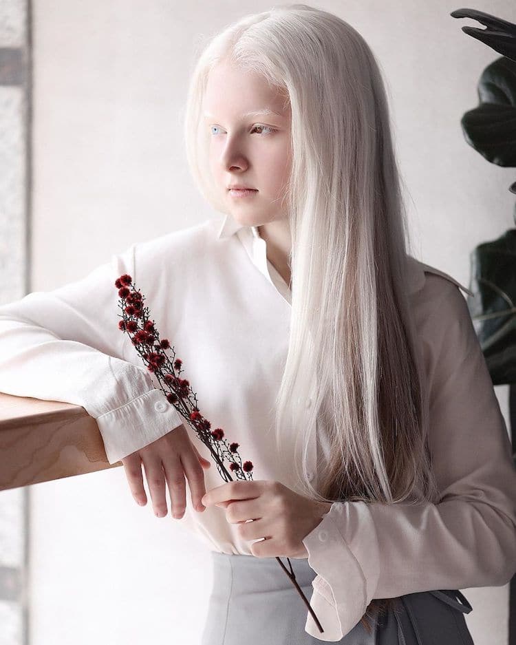Amina Ependieva, Girl With Heterochromia Albinism and d