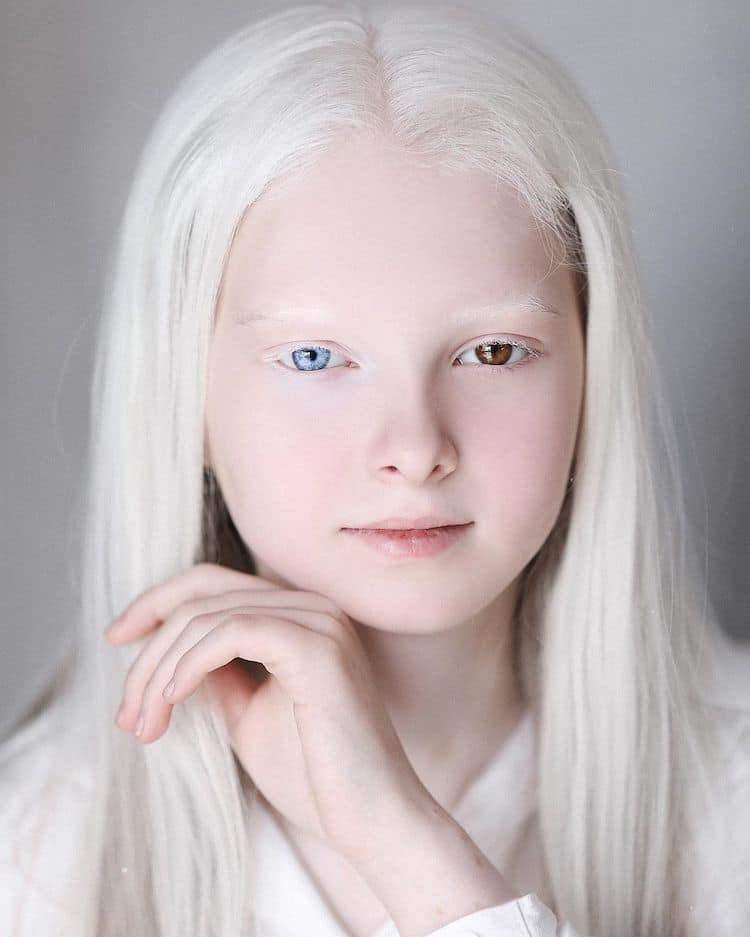 Amina Ependieva, Girl With Heterochromia Albinism and d