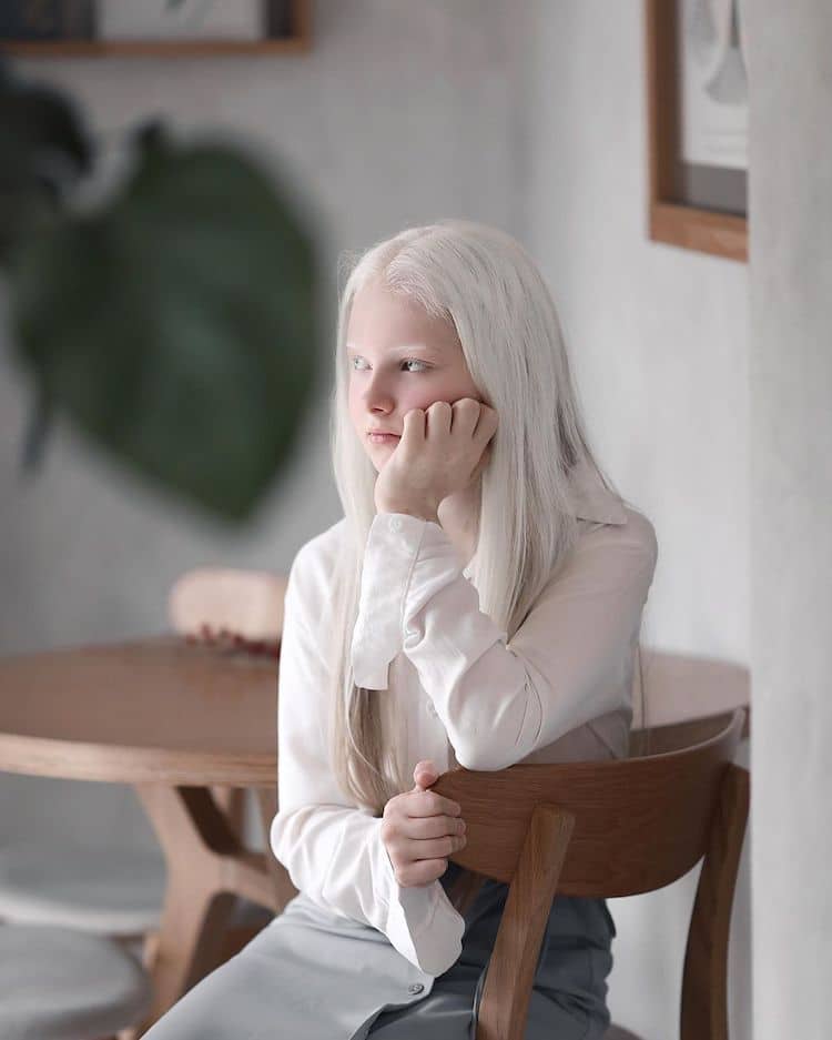 persona con albinismo y heterocromía