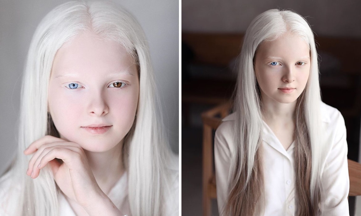Ребенок 6 лет бледный. Аниридия альбинизм.