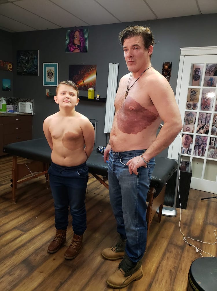 Dad Tattoos Son's Birthmark Across Chest