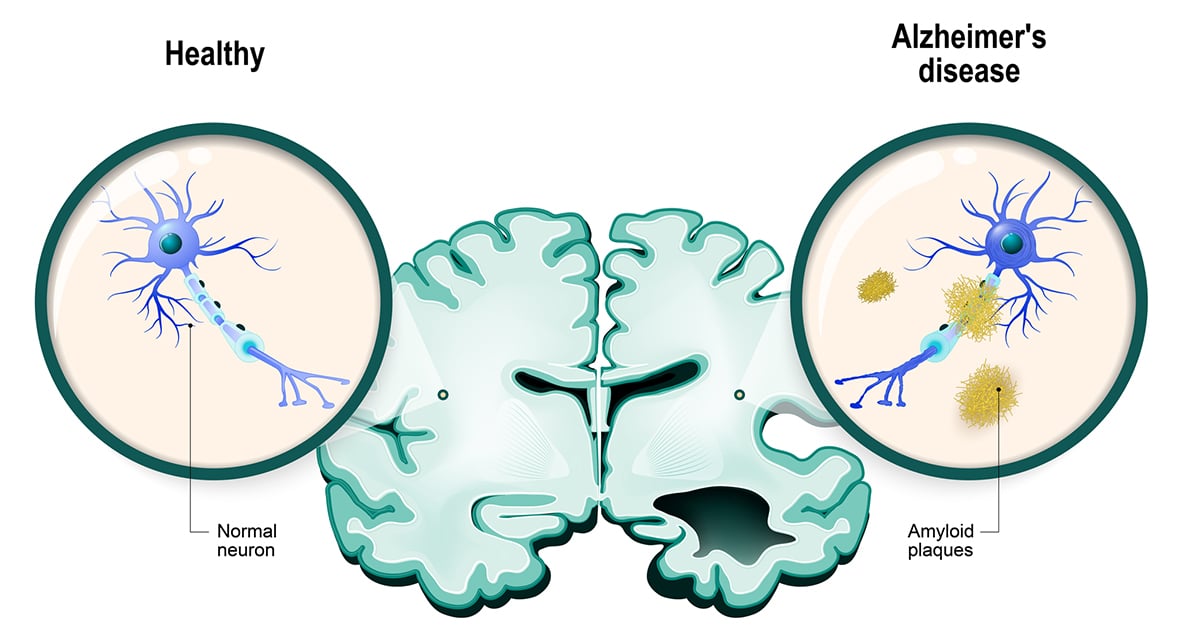 A Japanese Researcher Is Developing An Oral Alzheimer's Vaccine