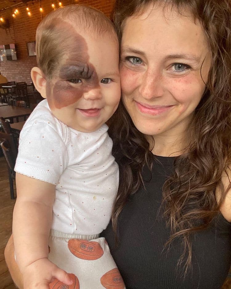 Beautiful from birth: Bullied for birthmark on her face but that