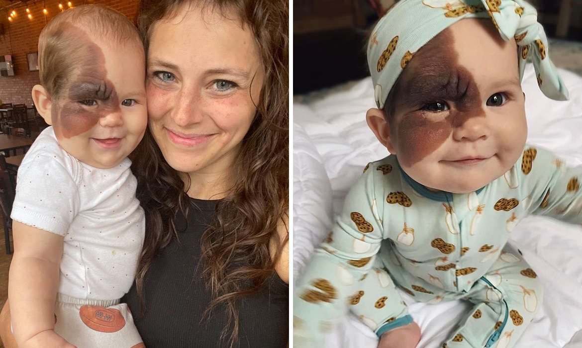 Mom Made It Mission to Show Daughter With Rare Birthmark Her Beauty