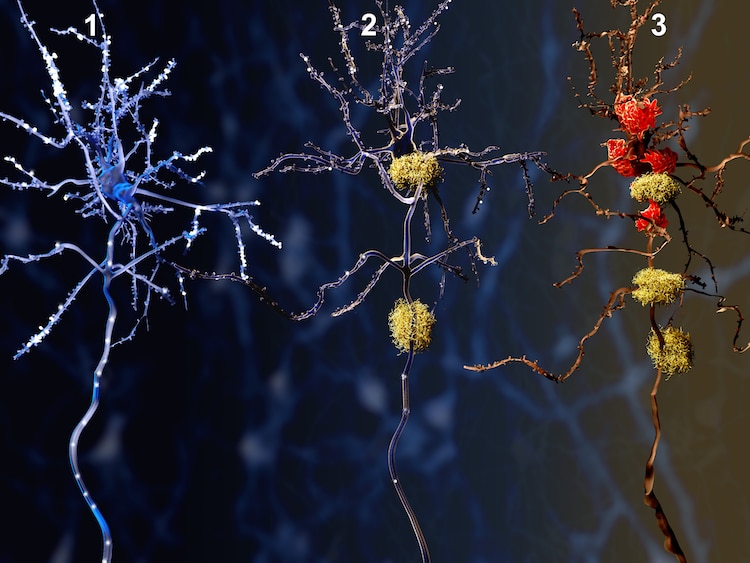 Illustration of the toxic protein amyloid beta