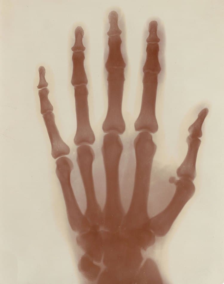 Nikola Tesla Hand X Ray