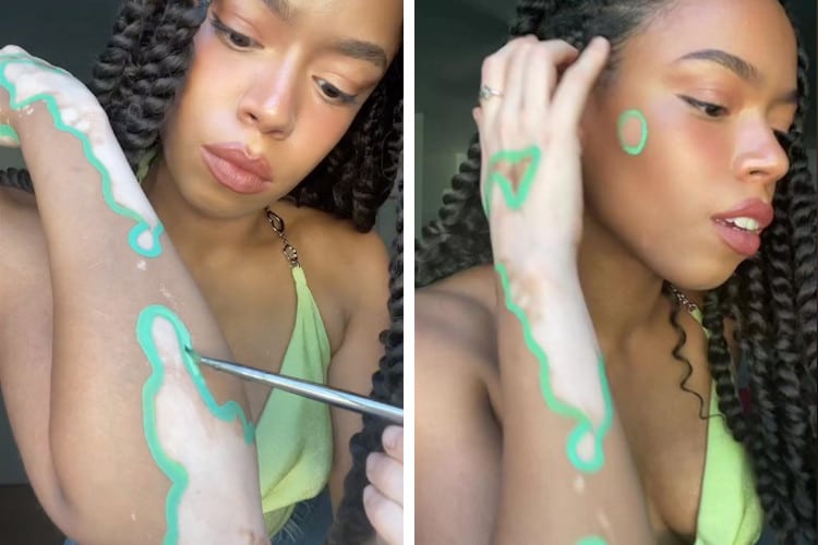 Woman With Vitiligo Transforms Her Skin Into Art Spots
