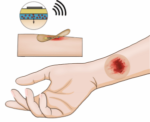 'Smart Bandage' Helps Heal Wounds