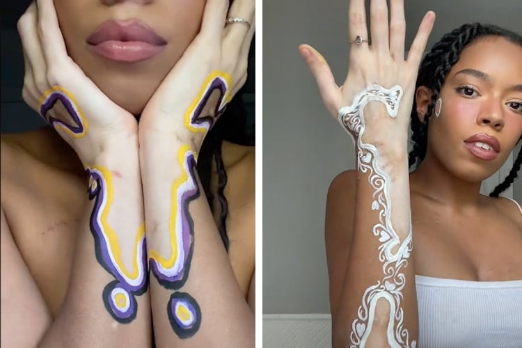 vitiligo models tumblr