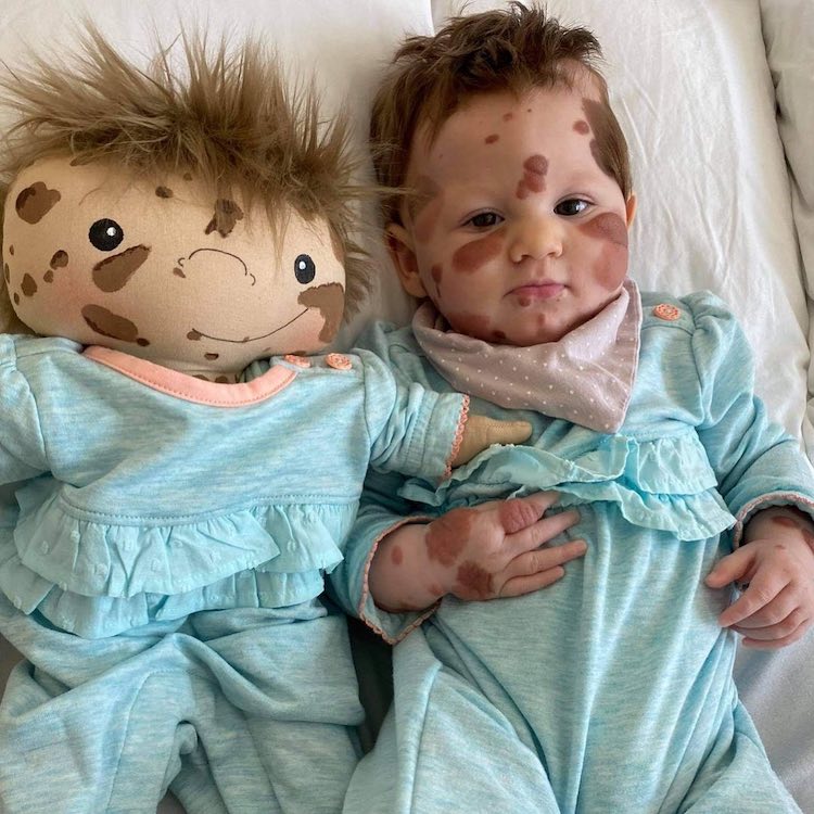 Former Social Worker Crafts Dolls Identical to Children Who Have Visible Physical Differences