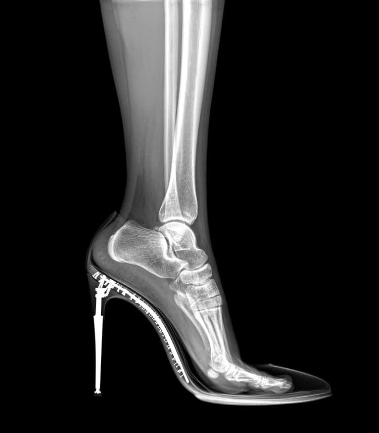 X-ray of a woman wearing a high heel