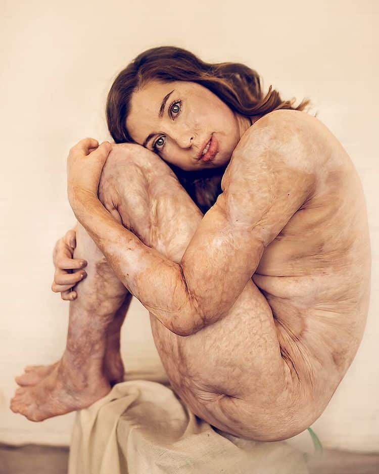 Ugly Scars On The Womans Legs Stock Photo - Download Image Now