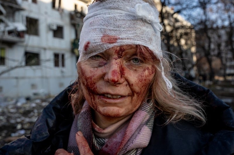 Ukrainian woman injured in the war