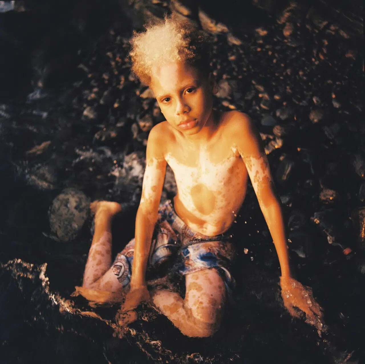 Young boy with vitiligo sitting in shorts