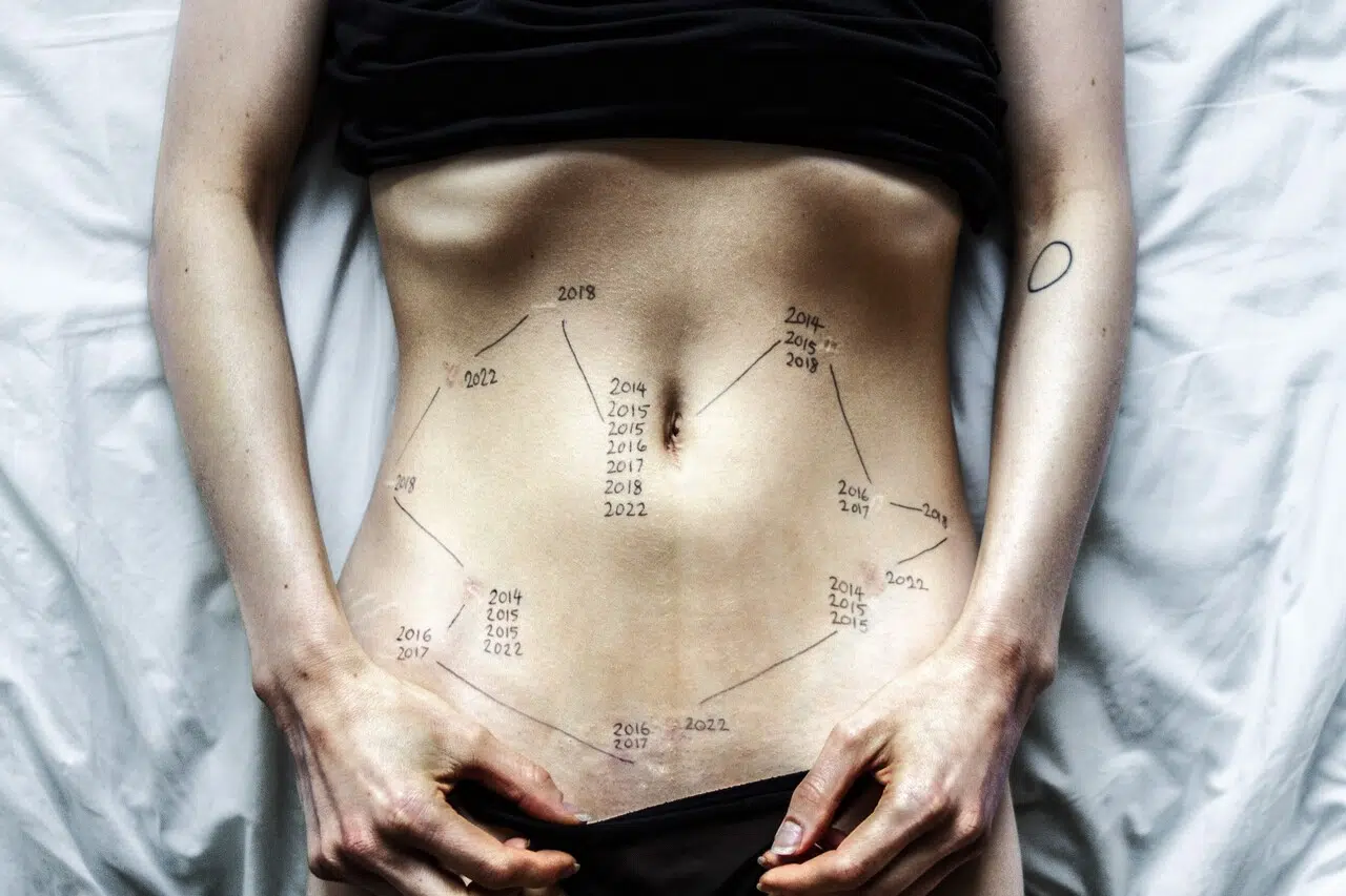 Woman's torso with markings on it from endometriosis treatments over five years